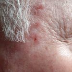 Basal Cell carcinoma Fades Away