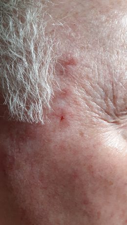 Basal Cell carcinoma Fades Away